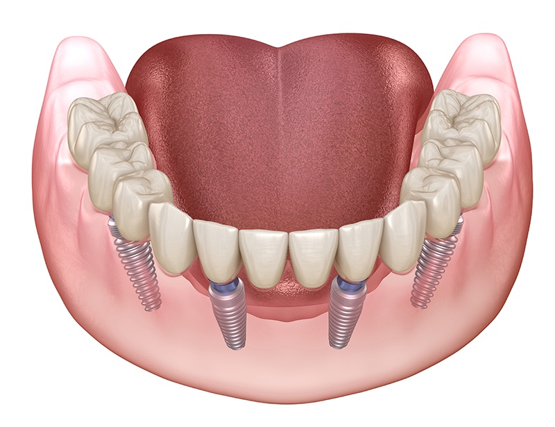 all on four implants graphic