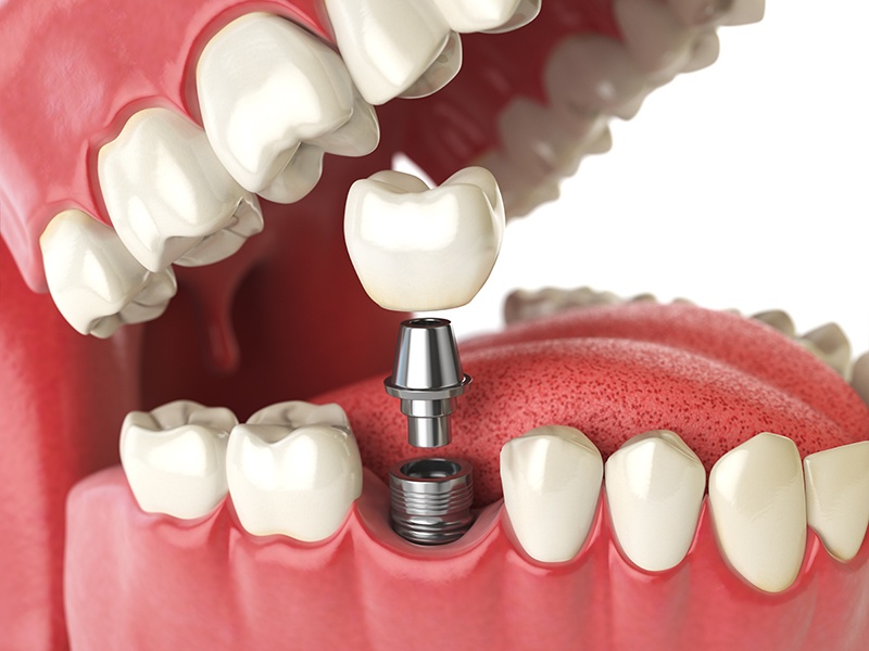 singe tooth implant graphic